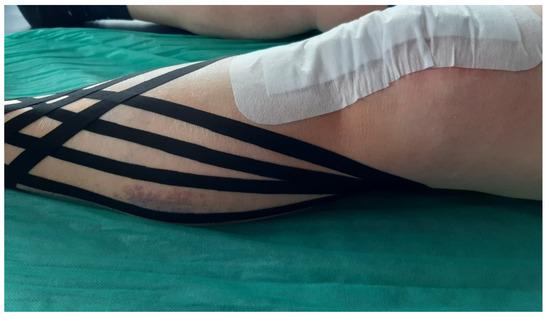 Lymph Taping - inainte