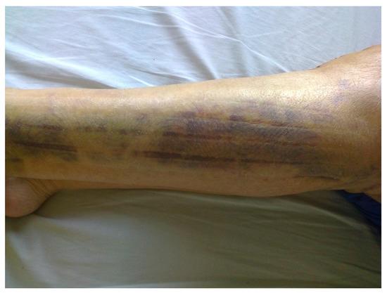 Lympgh Taping - dupa